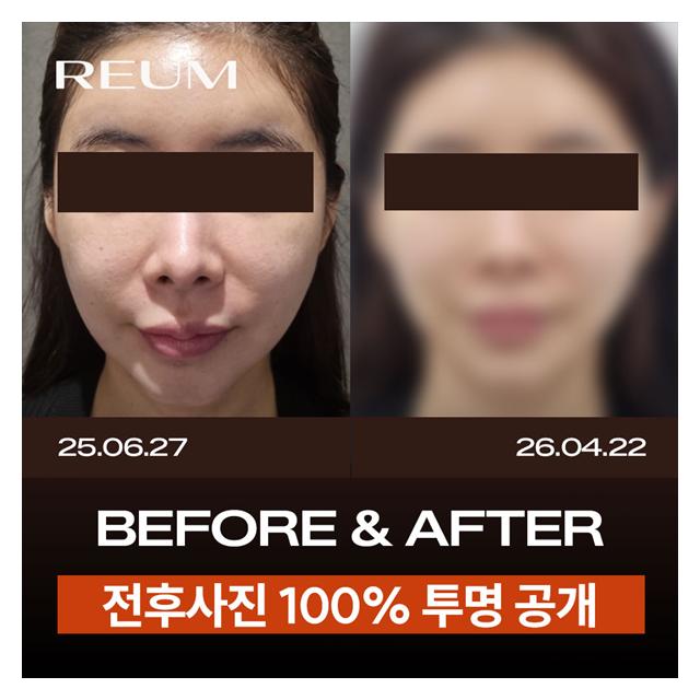 100% 보정없는 전후사진 투명 공개하는 리움의원입니다